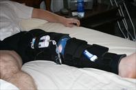 Laura taking off the bandages and re-dressing my knee after my surgery.