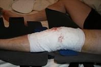 Laura taking off the bandages and re-dressing my knee after my surgery.