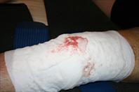 Laura taking off the bandages and re-dressing my knee after my surgery.