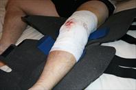 Laura taking off the bandages and re-dressing my knee after my surgery.