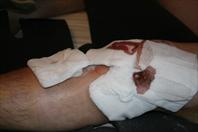 Laura taking off the bandages and re-dressing my knee after my surgery.