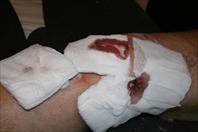 Laura taking off the bandages and re-dressing my knee after my surgery.
