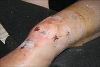 Laura taking off the bandages and re-dressing my knee after my surgery.