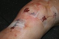 Laura taking off the bandages and re-dressing my knee after my surgery.