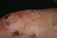 Laura taking off the bandages and re-dressing my knee after my surgery.