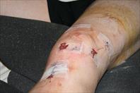 Laura taking off the bandages and re-dressing my knee after my surgery.