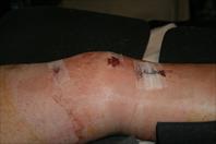 Laura taking off the bandages and re-dressing my knee after my surgery.