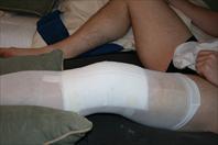 Laura taking off the bandages and re-dressing my knee after my surgery.