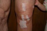 A few days after my ACLR surgery - Mary was kissing Daddies boo-boo - January 2009